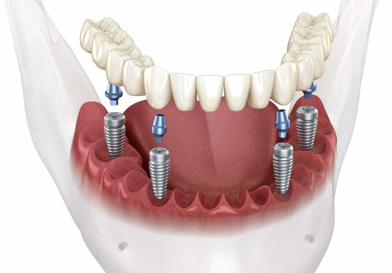 Life changing transformation with dental implants