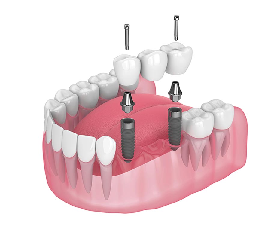 Bridge Supported Dental Implants