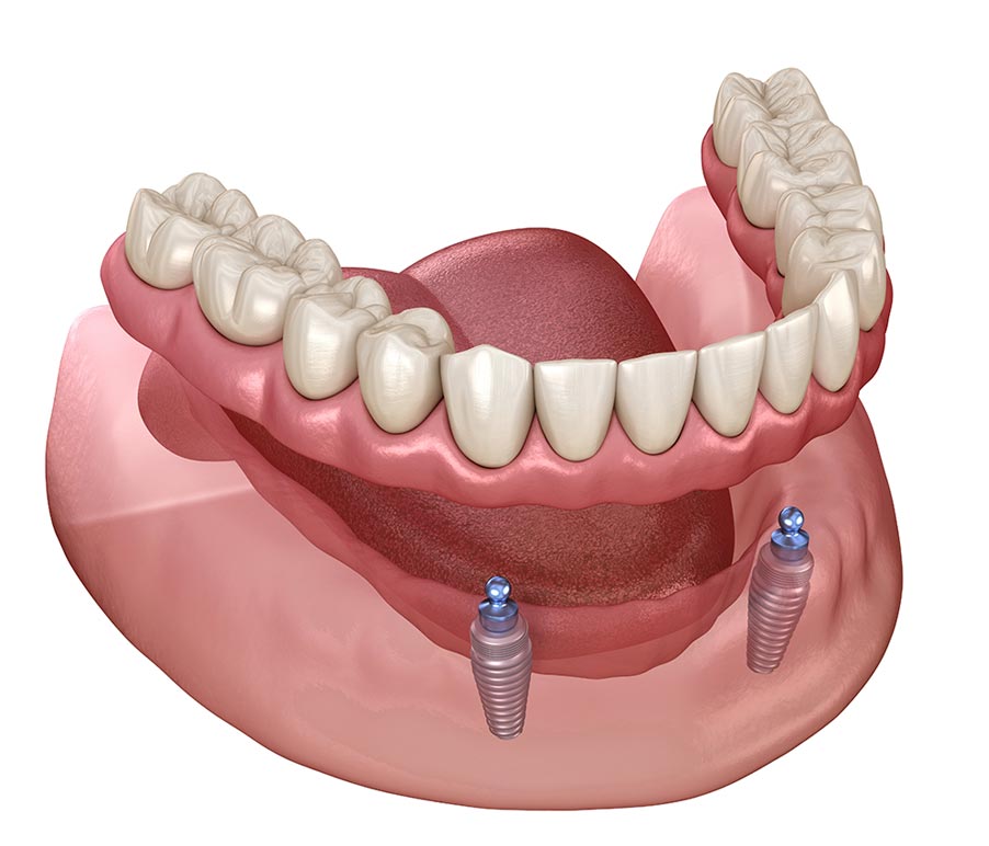 Zygomatic implants