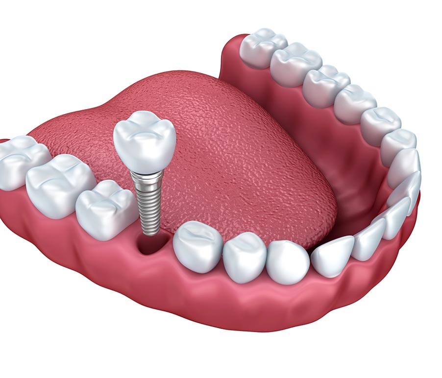 Single tooth implants